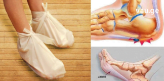 ქუსლის ძვლის დეზის მკურნალობა დიმექსიდით : ეს კომპრესი სწრაფი მშველელია !