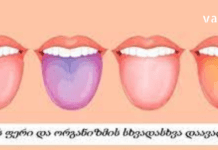 Შეხედეთ თქვენი ენის ფერს და გაიგებთ რომელი დაავადება გაწუხებთ