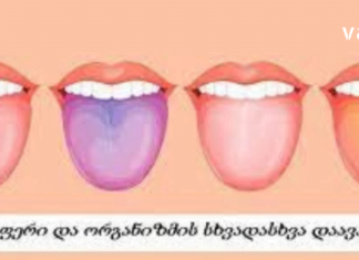 Შეხედეთ თქვენი ენის ფერს და გაიგებთ რომელი დაავადება გაწუხებთ