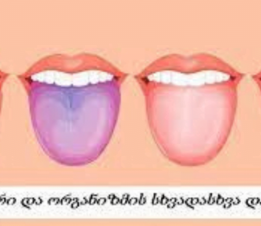 Შეხედეთ თქვენი ენის ფერს და გაიგებთ რომელი დაავადება გაწუხებთ