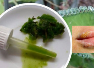 მომხმარებლის ნაამბობი, როგორ მოიცილა ჰერპესი სახლის პირობებში