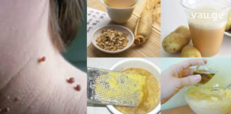 8 ყველაზე ეფექტური რეცეპტი პაპილომას სამკურნალოდ