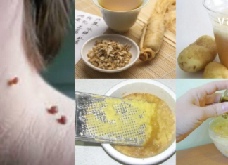 8 ყველაზე ეფექტური რეცეპტი პაპილომას სამკურნალოდ