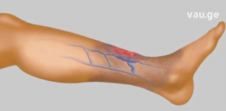 სისხლის Ცუდი ცირკულაცია, ცივი ფეხები და ხელები – აი, როგორ უნდა გადაიჭრას ეს პრობლემა!