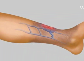 სისხლის Ცუდი ცირკულაცია, ცივი ფეხები და ხელები – აი, როგორ უნდა გადაიჭრას ეს პრობლემა!