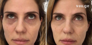 შეშუპებული და ჩაშავებული კანი თვალების ირგვლივ შეგიძლიათ ამ მარტივი ინგრედიენტების გამოყენებით სამუდამოდ დაივიწყოთ