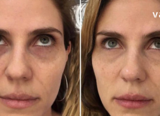 შეშუპებული და ჩაშავებული კანი თვალების ირგვლივ შეგიძლიათ ამ მარტივი ინგრედიენტების გამოყენებით სამუდამოდ დაივიწყოთ