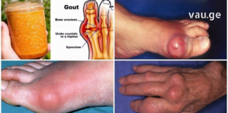 ამის შემდეგ სამუდამოდ განიკურნებით პოდაგრასგან! ამ წამლის ეფექტურობა დადასტურებულია..