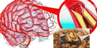 თავის ტვინის სისხლძარღვების გაწმენდა: მარტივი რეცეპტები და რჩევები