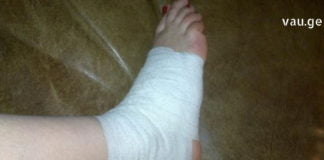 თუ არ იცით რა მოიმოქმედოთ ნაღრძობის, დაჟეჟილობისა და მოტეხილობის მოსარჩენად, გაგიზიარებთ ეფექტურ რეცეპტს.