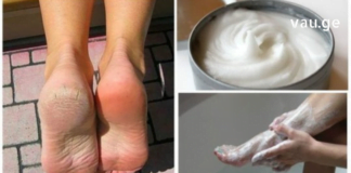 ეს წამალი დახეთქილი ქუსლების პრობლემას მხოლოდ 10 დღეში მოგაშორებთ