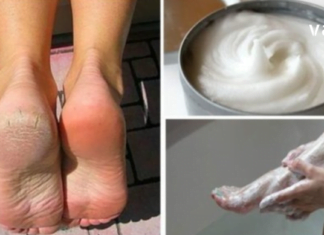 ეს წამალი დახეთქილი ქუსლების პრობლემას მხოლოდ 10 დღეში მოგაშორებთ