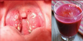 დაამარცხეთ გლანდების ანთება სულ რაღაც 24 საათში : დროში გამოცდილი ყველაზე ეფექტური მეთოდი!