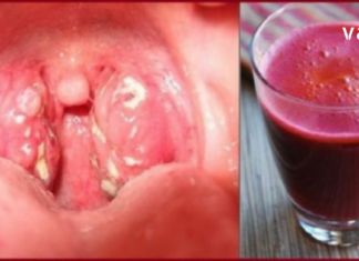 დაამარცხეთ გლანდების ანთება სულ რაღაც 24 საათში : დროში გამოცდილი ყველაზე ეფექტური მეთოდი!