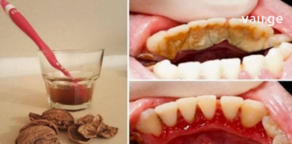 ნადები და ქვები კბილებიდან 5 წუთში გაქრება-ეფექტური მეთოდი თქვენთვის!