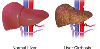 6 ჩვევა, რომლიც აზიანებს თქვენს ღვიძლს. ამის შესახებ უნდა იცოდეთ, რომ შემდეგ გვიან არ იყოს.