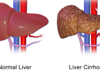 6 ჩვევა, რომლიც აზიანებს თქვენს ღვიძლს. ამის შესახებ უნდა იცოდეთ, რომ შემდეგ გვიან არ იყოს.