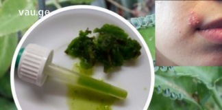 დღეიდან თქვენ არ ინერვიულებთ გარეგნული იერის გამო, როცა ჰერპესის ინფექცია მწვავდება: ამ სტატიაში შეიტყობთ, როგორ უმკურნალოთ ჰერპესს სახლის პირობებში.