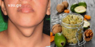 5 პროდუქტი, რომელიც საუკეთესოა ჩიყვის სამკურნალოდ!