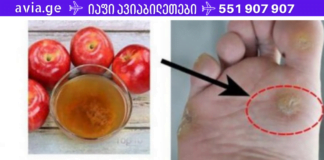 მამაჩემმა მოიშორა მეჭეჭები სამედიცინო ჩარევების გარეშე – თუ ამ დრომდე ებრძვით მეჭეჭებს აუცილებლად წაიკითხეთ ეს!