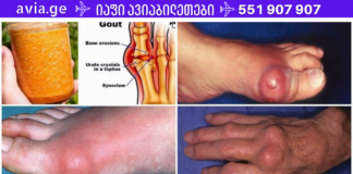ეს საშუალება უბრალოდ გასაოცარია! სულ რაღაც 2 დღეში შეგიმსუბუქებთ პოდაგრას ტკივილს. ახლა უკვე ადვილია პოდაგრას მკურნალობა სახლის პირობებში!