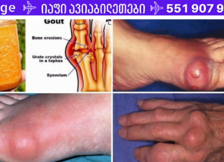 ეს საშუალება უბრალოდ გასაოცარია! სულ რაღაც 2 დღეში შეგიმსუბუქებთ პოდაგრას ტკივილს. ახლა უკვე ადვილია პოდაგრას მკურნალობა სახლის პირობებში!