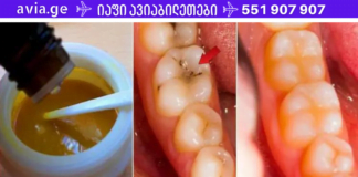 8 მარტივი ნაბიჯი, რომელიც ადვილად აგაცილებთ კარიესს! ამის ცოდნა აუცლებელია!