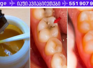 8 მარტივი ნაბიჯი, რომელიც ადვილად აგაცილებთ კარიესს! ამის ცოდნა აუცლებელია!