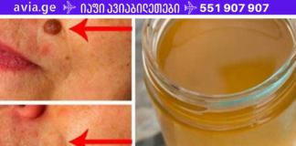 ეფექტური მეთოდები მეჭეჭების მოსაცილებლად! ექიმები გაოცებული არიან, უმოკლეს დროში აქვს ეფექტი!