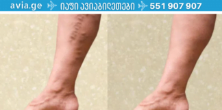 ჯადოსნური 2-კომპონენტიანი რეცეპტი თრომბოზისა და ვარიკოზული ვენებისთვის. ეს უნდა სცადოთ!