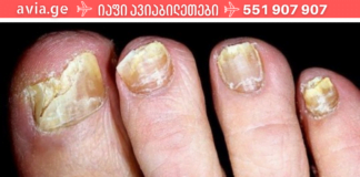 ამ მეთოდის წყალობით სამუდამოდ გავიქრე ფრჩხილებზე სოკო! ეს უნდა წაიკითხო!