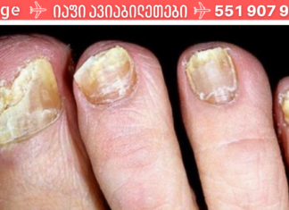 ამ მეთოდის წყალობით სამუდამოდ გავიქრე ფრჩხილებზე სოკო! ეს უნდა წაიკითხო!