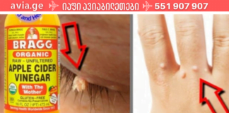 აი როგორ უნდა მოიშოროთ მეჭეჭები და პაპილომები უმტკივნეულოდ ხალხური საშალებებით! მე დღითიდღე მაოცებს შედეგი!