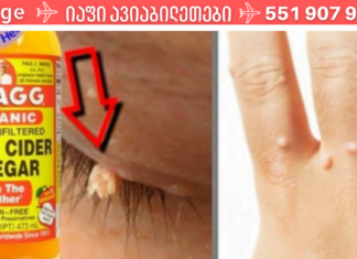 აი როგორ უნდა მოიშოროთ მეჭეჭები და პაპილომები უმტკივნეულოდ ხალხური საშალებებით! მე დღითიდღე მაოცებს შედეგი!