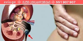 თუ თირკმელებში კენჭები გაქვთ მიმართეთ ამ მეთოდს! სასწაული შედეგი აქვს!