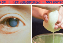 უმკურნალეთ კატარაქტას ხალხური, მეტად ეფექტური საშუალებით! მე მხოლოდ ამან მიშველა!