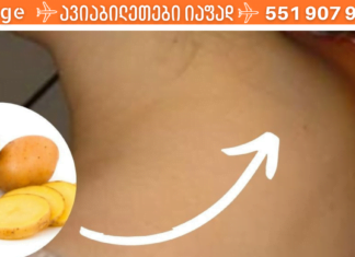 თუ კისერზე მარილები დაგიგროვდათ, კარტოფილის კომპრესები მოგიხსნით გაუსაძლის ტკივილებს!