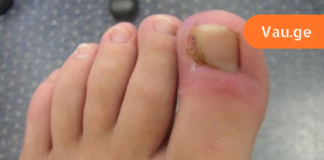 თუ ფრჩხილი ასე ჩაგეზარდათ ეს სტატია აუცილებლად წაიკითხეთ! საბედნიეროდ არსებობს წამალი, რომელიც დროულად დაგეხმარებათ!