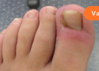 თუ ფრჩხილი ასე ჩაგეზარდათ ეს სტატია აუცილებლად წაიკითხეთ! საბედნიეროდ არსებობს წამალი, რომელიც დროულად დაგეხმარებათ!