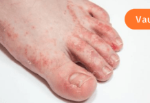 გაინტერესებთ როგორ უნდა გაუმკლავდეთ ტერფის სოკოს სახლის პირობებში? მაშინ ეს სტატია დროულად წაიკითხეთ!! გარანტირებული შედეგი!