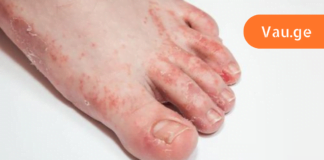 გაინტერესებთ როგორ უნდა გაუმკლავდეთ ტერფის სოკოს სახლის პირობებში? მაშინ ეს სტატია დროულად წაიკითხეთ!! გარანტირებული შედეგი!