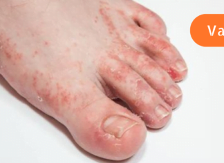 გაინტერესებთ როგორ უნდა გაუმკლავდეთ ტერფის სოკოს სახლის პირობებში? მაშინ ეს სტატია დროულად წაიკითხეთ!! გარანტირებული შედეგი!