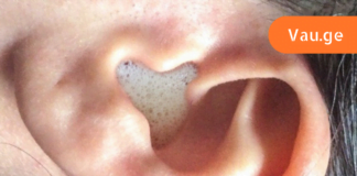 ნატურალური საშუალებები სმენის გასაუმჯობესებლად! თავიდან აიცილეთ სიყრუის საშიშროება!!!