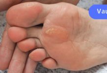 კოჟრები და მაზოლები: ამ რეცეპტების გამოყენების შემდეგ მარტივად გაიქრობთ მათ!