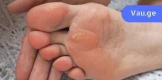 კოჟრები და მაზოლები: ამ რეცეპტების გამოყენების შემდეგ მარტივად გაიქრობთ მათ!