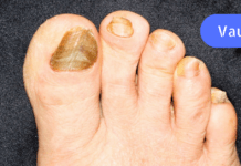 ჩასანიშნი რეცეპტი! – კვერცხის მალამო ფრჩხილის სოკოს და სახსრების სამკურნალოდ! მარტივი, ეფექტური და სწრაფი მეთოდი!