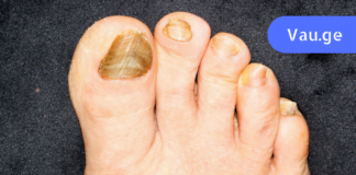 ჩასანიშნი რეცეპტი! – კვერცხის მალამო ფრჩხილის სოკოს და სახსრების სამკურნალოდ! მარტივი, ეფექტური და სწრაფი მეთოდი!