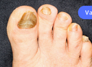 ჩასანიშნი რეცეპტი! – კვერცხის მალამო ფრჩხილის სოკოს და სახსრების სამკურნალოდ! მარტივი, ეფექტური და სწრაფი მეთოდი!