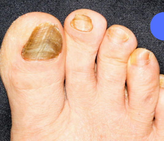 ჩასანიშნი რეცეპტი! – კვერცხის მალამო ფრჩხილის სოკოს და სახსრების სამკურნალოდ! მარტივი, ეფექტური და სწრაფი მეთოდი!