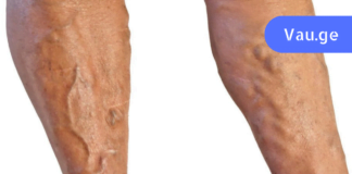 ყველაზე ძვირფასი წამალი ვარიკოზული ვენების სამკურნალოდ! გამოდგება ყველა სეზონზე!!!